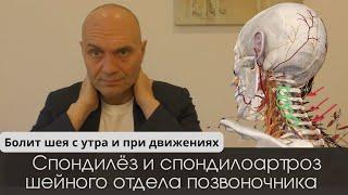 БОЛИТ ШЕЯ С УТРА И ПРИ ДВИЖЕНИЯХ спондилёз и спондилоартроз шейного отдела позвоночника Симптомы