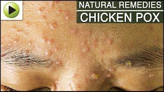 Skin Care - Chicken Pox - Natural Ayurvedic Home Remedies