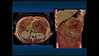 SPEN Tumors of the Pancreas 2021 What You Need to Know - Part 1