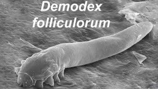 Demodex Folliculorum Железница Угревая - Морфология Жизненный цикл Профилактика Диагностика