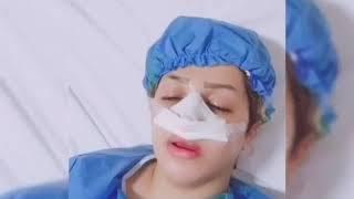 نتیجه عمل بینی در مشهد  عمل بینی گوشتی زنانه توسط دکتر مهدی رمضانی یکی از بهترین جراحان بینی مشهد