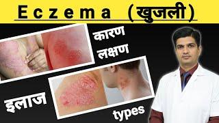 Eczema Treatment  Eczema kya hota hai