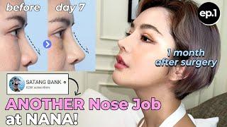 SUB Influencers New NoseSuccessful Revisional Rhinoplasty at NANA Plastic Surgery Hospital