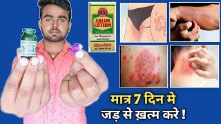 Zalim Lotion Uses In Hindi  दाद  खाज  खुजली  दिनाव  फंगल इन्फेक्शन को जड़ से ख़त्म करे