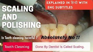How Scaling is done ?  Teeth cleaning  Scaling and Polishing