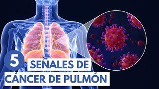 5 señales de cáncer de pulmón  Animación 3D