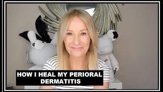 PERIORAL DERMATITIS - HOW I TREAT MY SKIN FLARE UPS