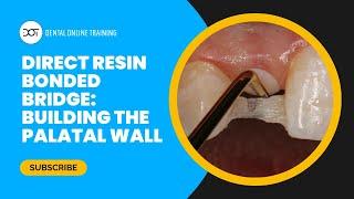 Direct Resin Bonded Bridge Course Preview - Building the Palatal Wall  Dental Online Training