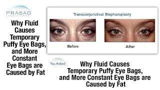 How Fluid Causes Temporary Puffy Eyes and Why Constant Eye Bags are Caused by Fat