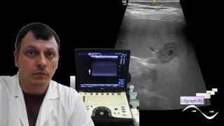 Pediatric Abdominal Ultrasound - Hypoechoic spleen lesion