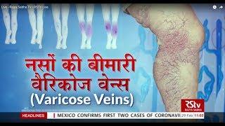 Ayushman Bhava वैरिकोज वेन्स - नसों की बीमारी  Symptoms & Prevention of Varicose Veins