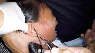 Removing Something Trapped in Girls Ear . Its STUCK