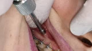 Mini screw mini implant insertion  screwing in orthodontic #mini_implant TAD