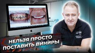 НЕЛЬЗЯ просто поставить ВИНИРЫ. ЧТО НУЖНО сделать перед установкой виниров. Установка виниров 16+