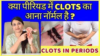 क्या पीरियड में CLOTS का आना नॉर्मल है ? CLOTS IN PERIOD