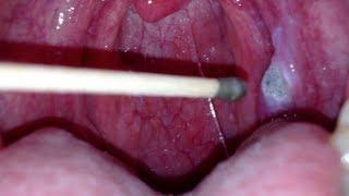silver nitrate burning of a canker sore