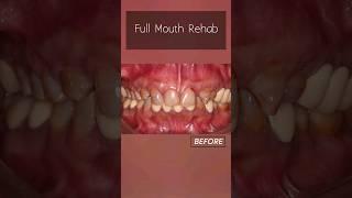 Full Mouth Rehab # #dentist #teethtreatment #indiandentist #dentalcare #smile #indore #smiledesign