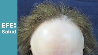 Alopecia frontal fibrosante angustia de mujer