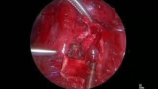 Asvide Video-assisted flap bronchoplasty for central type typical carcinoid.