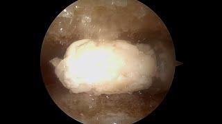 Foot and Ankle Arthroscopic Arthrodesis Augmented Using the GraftNet™ Device