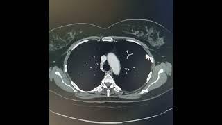 Left lower lobe basal segments collapse consolidation and bronchiectasis.