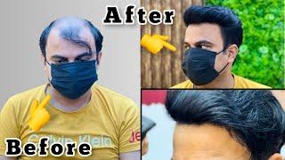 Hair Patches for Mens in India  Wigs For Mens  Lucknow  6392117438  Jaipur  9717861351
