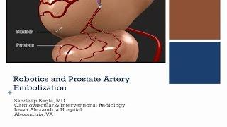 Advantages of Prostate Artery Embolization with the Magellan Robotic System