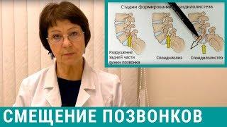 Смещение позвонков спондилолистез поясничного отдела позвоночника - лечение