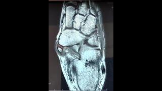 The Accessory Navicular - Clinical Radiographic and Surgical Assessment