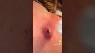 Giant Cyst Exploding
