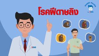 EP25 โรคฝีดาษลิงฝีดาษวานร Monkeypox