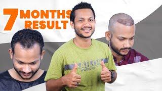 Miracle Hair Restoration Grade 3 Baldness Reversed in 7 Months   Hair Transplant Bangladesh