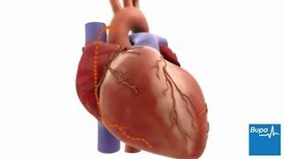 How coronary artery bypass graft CABG surgery is carried out