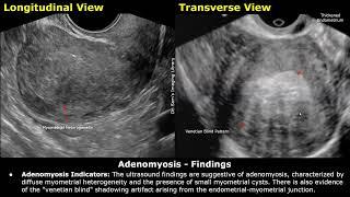 Adenomyosis Ultrasound Report Example  Uterus USG Scan Reporting  Gynecological Sonography Cases