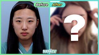 TOP 5 Plastic Surgery Before and After l Extreme Face Makeover l Transformation in Korea