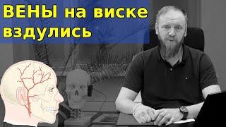  Вена на виске вздулась и пульсирует причина и как убрать