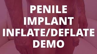 Penile Implant Demo inflatedeflate - 6 Months Post-Op