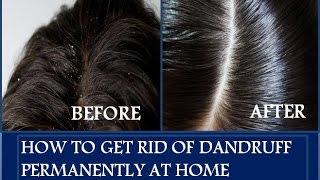 How to get rid of Dandruff permanently within a week - Home Remedies - 100% working