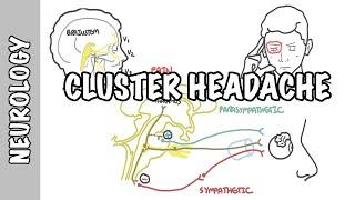 Cluster Headaches - symptoms pathophysiology treatment