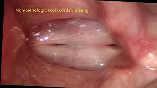 Mucus accumulation Postnasal drip and the human voice