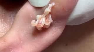 Massive Earlobe CYST Epidermoid Cyst Removal