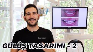 Gülüş Tasarımı Nasıl Yapılır? 2.vaka incelememiz