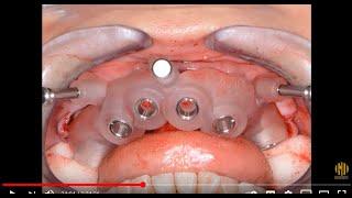 All on 6 dental implant procedure - overviewsteps by Dr. Ara Nazarian