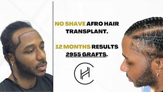 NO SHAVED Afro Hair Transplant Results - 2955 GRAFTS  12 MONTHS