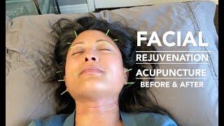 I Did Facial Rejuvenation Acupuncture - Before and After