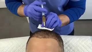 PRP treatment post FUE transplant at Dynamic Regenerative Medicine Birmingham Platelet Rich Plasma