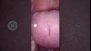 Are these Tonsils too Big?