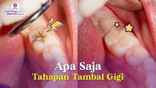 TAHAPAN DAN PROSES TAMBAL GIGI APA SAJA SIH ?