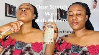 How to get rid of Stretch marks with Palmers Skin Therapy Oil