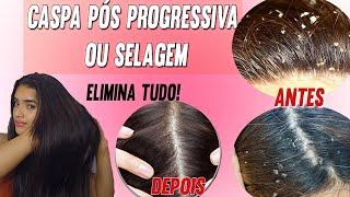 COMO SE LIVRAR DAS CASQUINHAS PÓS QUÍMICA? #hair#tratamento#caspa#progressive#foryoutube #views#como